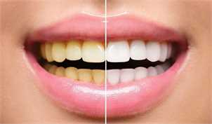 آیا پوست گردو دندان را سفید میکند؟